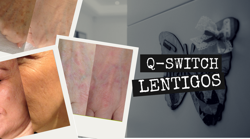 Q-Switch RevLite para lentigos
