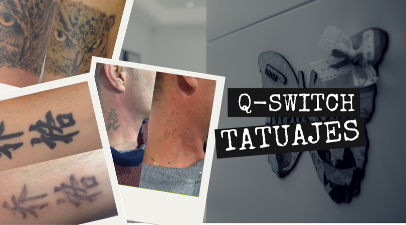 Q-Switch RevLite para tatuajes