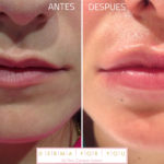 antes y despues de Relleno de labios con acido hialuronico