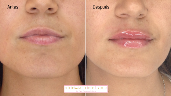 Rellenos de labios con resultados naturales - Dermaforyou
