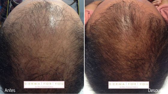 Alopecia androgénica masculina - Dermaforyou