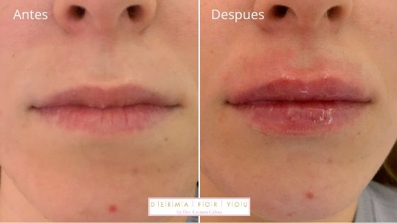 Antes y después de aumento de labios con Volift - Dermaforyou