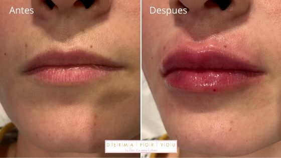 Resultados aumento de labios - Dermaforyou