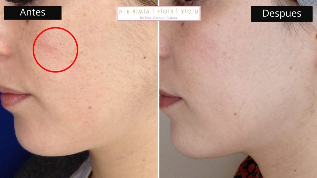 Sistema Skinlayer - Tratamiento de marcas de acné boxcar (perfil izq) - Dermaforyou