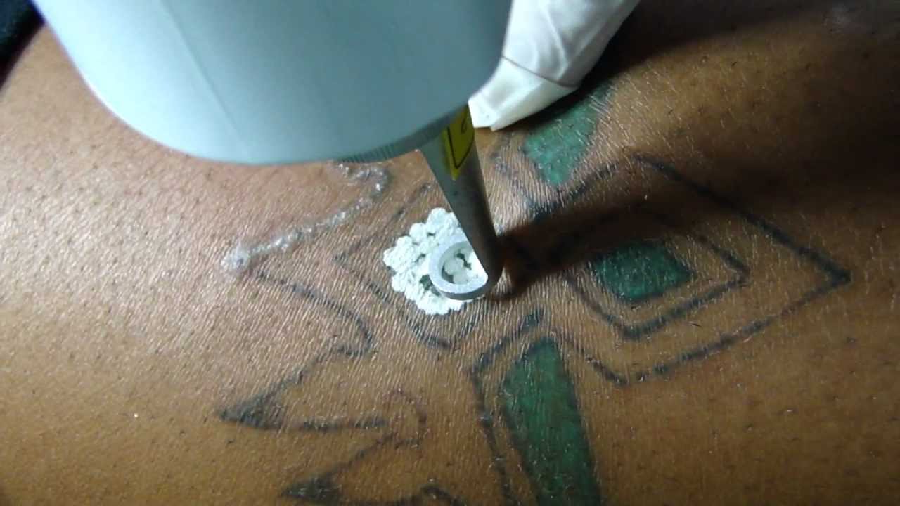 Eliminación de Tatuajes en Talavera con Láser Q-switched