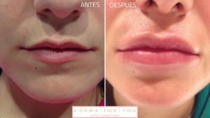 antes y despues de Relleno de labios con acido hialuronico