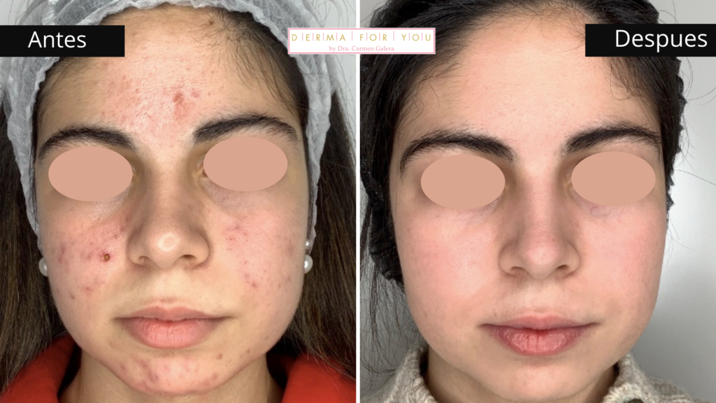 Tratamiento para las cicatrices de acné adolescente - Dermaforyou